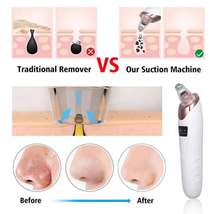 Face Vacuum Suction Blackhead Remover Pore Cleaner ...?